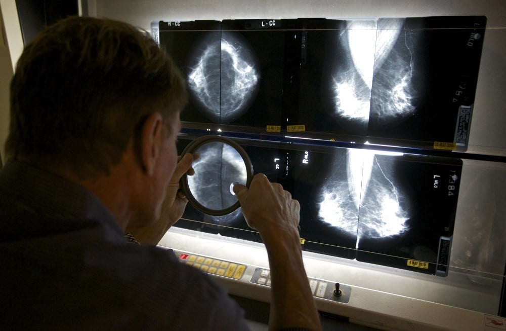 Breast cancer: Test means fewer women will need chemo